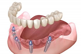 Exploded illustration of implant dentures