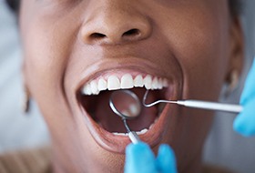 Nose-to-chin closeup of woman’s mouth being examined with dental instruments