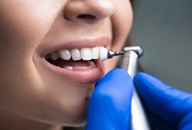 Nose-to-chin closeup of woman’s teeth being polished during cleaning