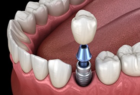 Animation of implant dental crown placement
