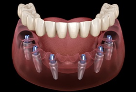 Animation of implant denture placement