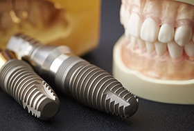 Model smile and dental implant posts