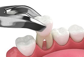 Illustration of a tooth being extracted