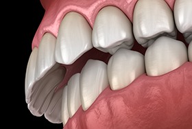 Illustration of teeth with overbite
