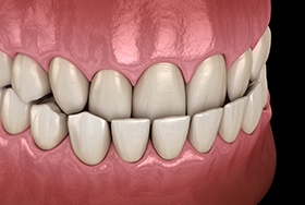 Illustration of teeth with underbite