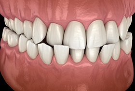 Illustration of teeth with crossbite