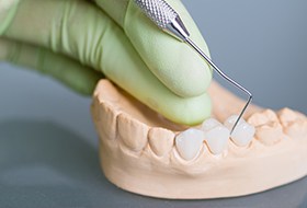 Model smile with fixed bridge restoration