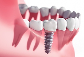 Animation of implant supported dental crown