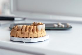 model of a mouth with porcelain veneers on it