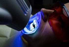 a patient undergoing in office teeth whitening