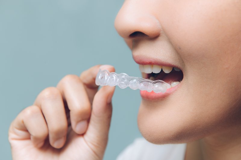 Person receiving clear aligners from dentist