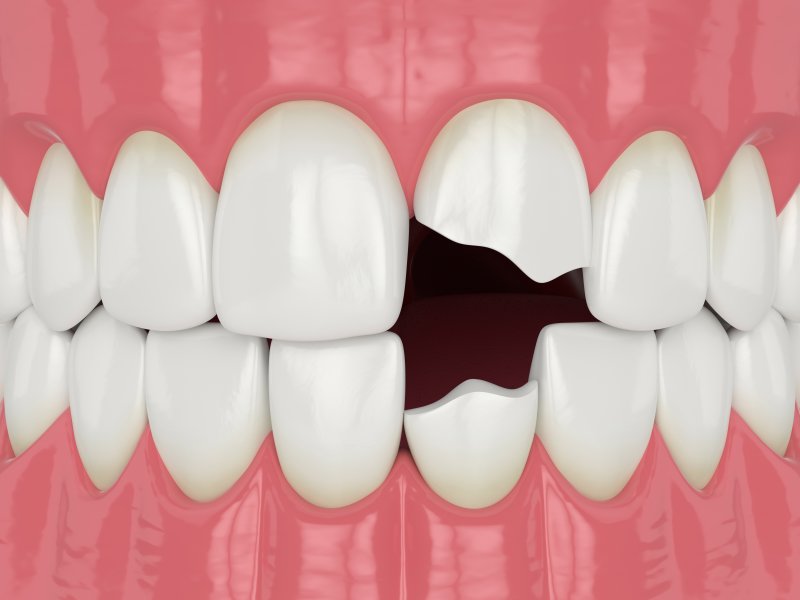 3D illustration of chipped tooth