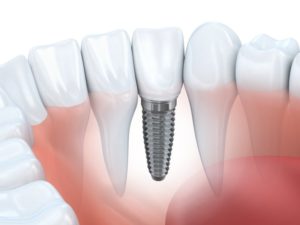 digital illustration of a placed dental implant